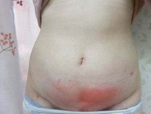 Angelic VenusAfter Her Surgery